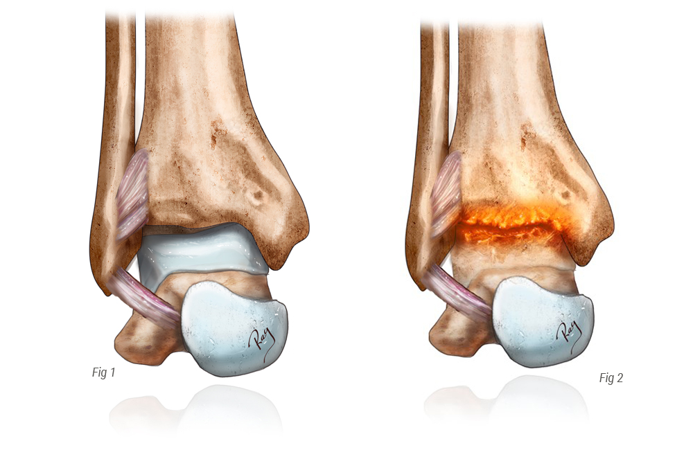 Arthrose de Cheville