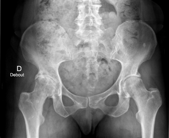 Coxarthrose