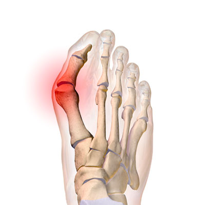 Hallux Valgus