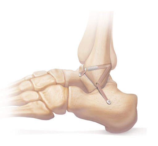 Ligamentoplastie de Cheville