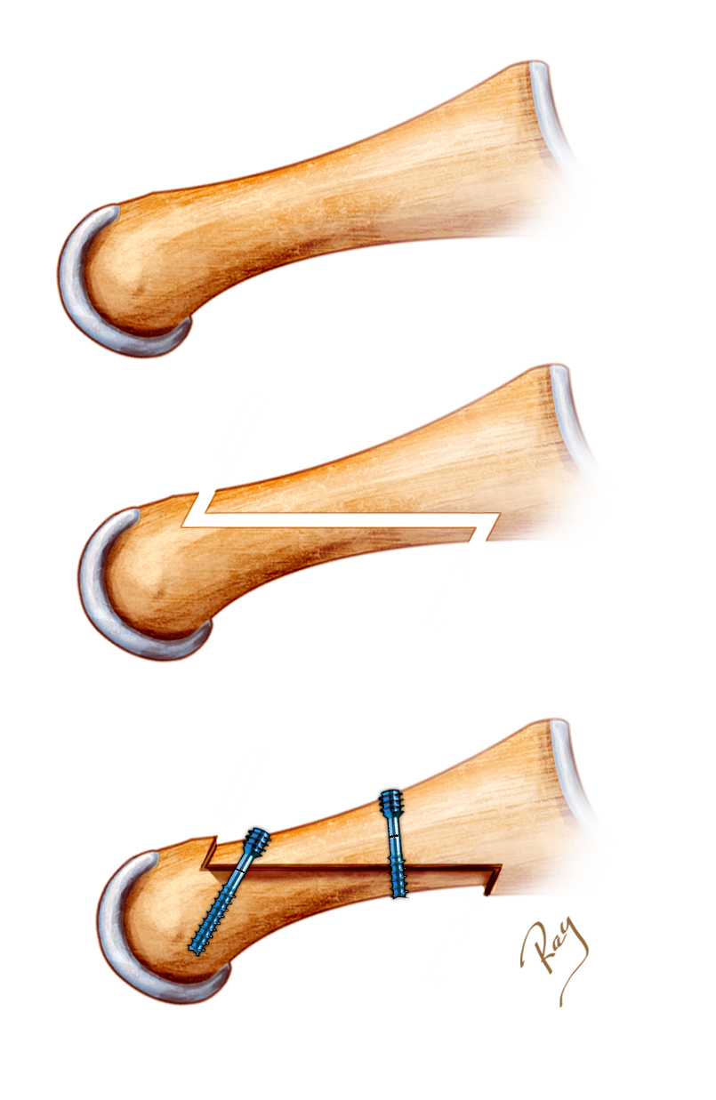 Ostéotomie de Scarf pour Hallux Valgus