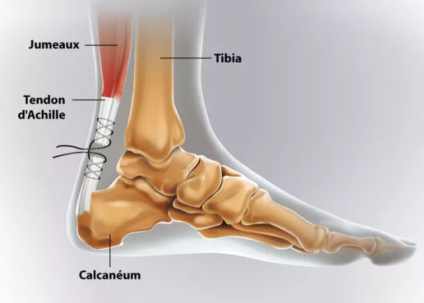 Chirurgie du Tendon d'Achille